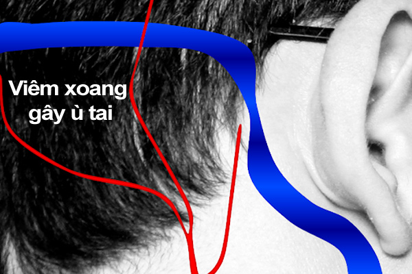 ù tai khi bị viêm xoang