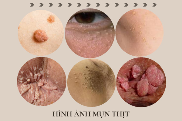 cách trị mụn thịt