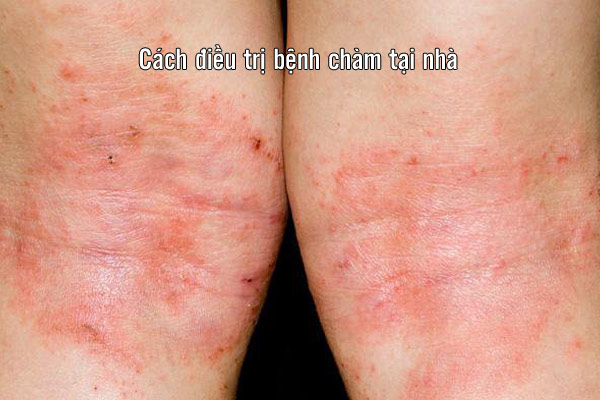cách điều trị bệnh chàm