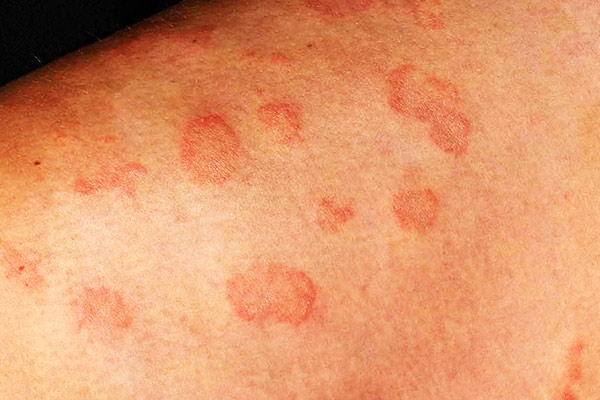 Bệnh chàm đồng tiền