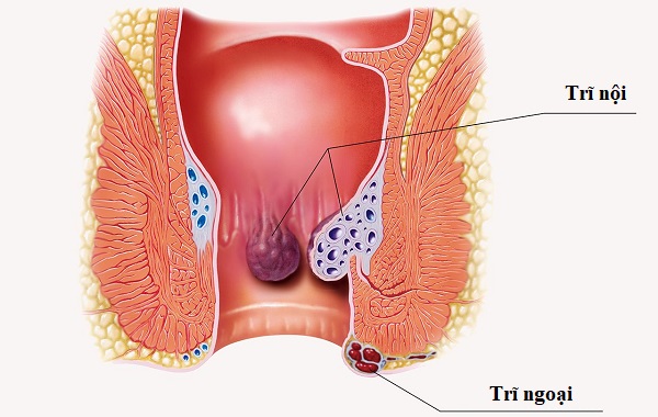 Bệnh trĩ gây chảy máu hậu môn nhưng không đau