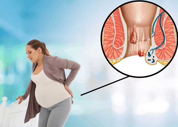 Bà bầu bị trĩ phải làm sao