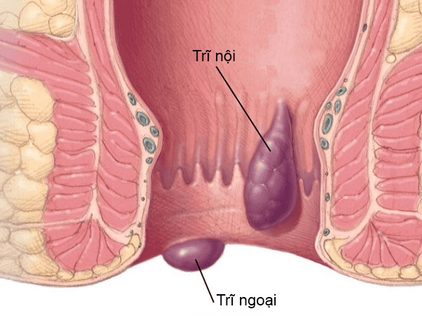 Sa búi trĩ ra ngoài hậu môn gây đau đớn, khó chịu cho người bệnh